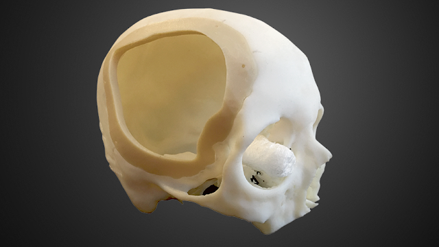 Emprendedores mexicanos reconstruyen cráneos con impresión 3D