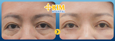 Hình ảnh khách hàng trước và sau khi lấy mỡ mí mắt nội soi tại KIM.