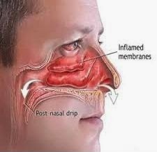 nasal drip and sore throat