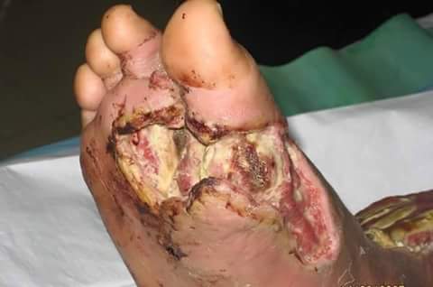 kaki luka akibat kencing manis