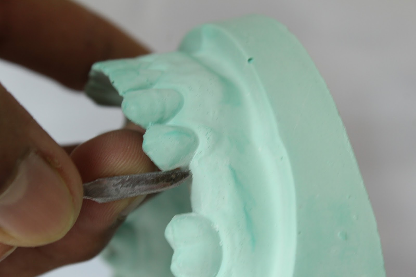 Understanding Prosthodontics Tagore Dental College & HospitalBy