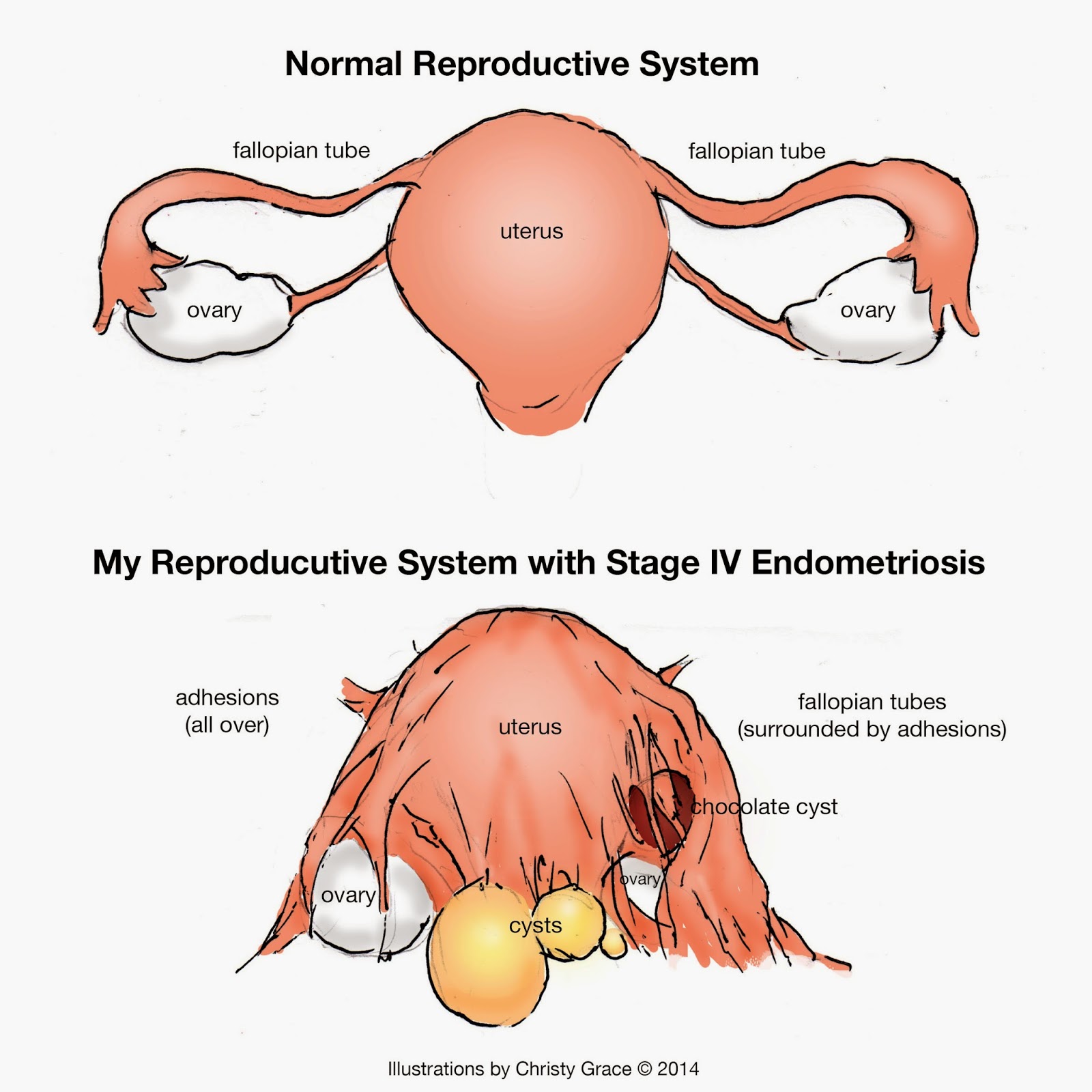 Does Endometriosis Go Away After Surgery Does Endometriosis Go Away After Surgery