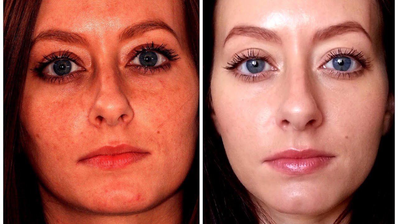 Micro Laser Peel Side Effects Effect Choices