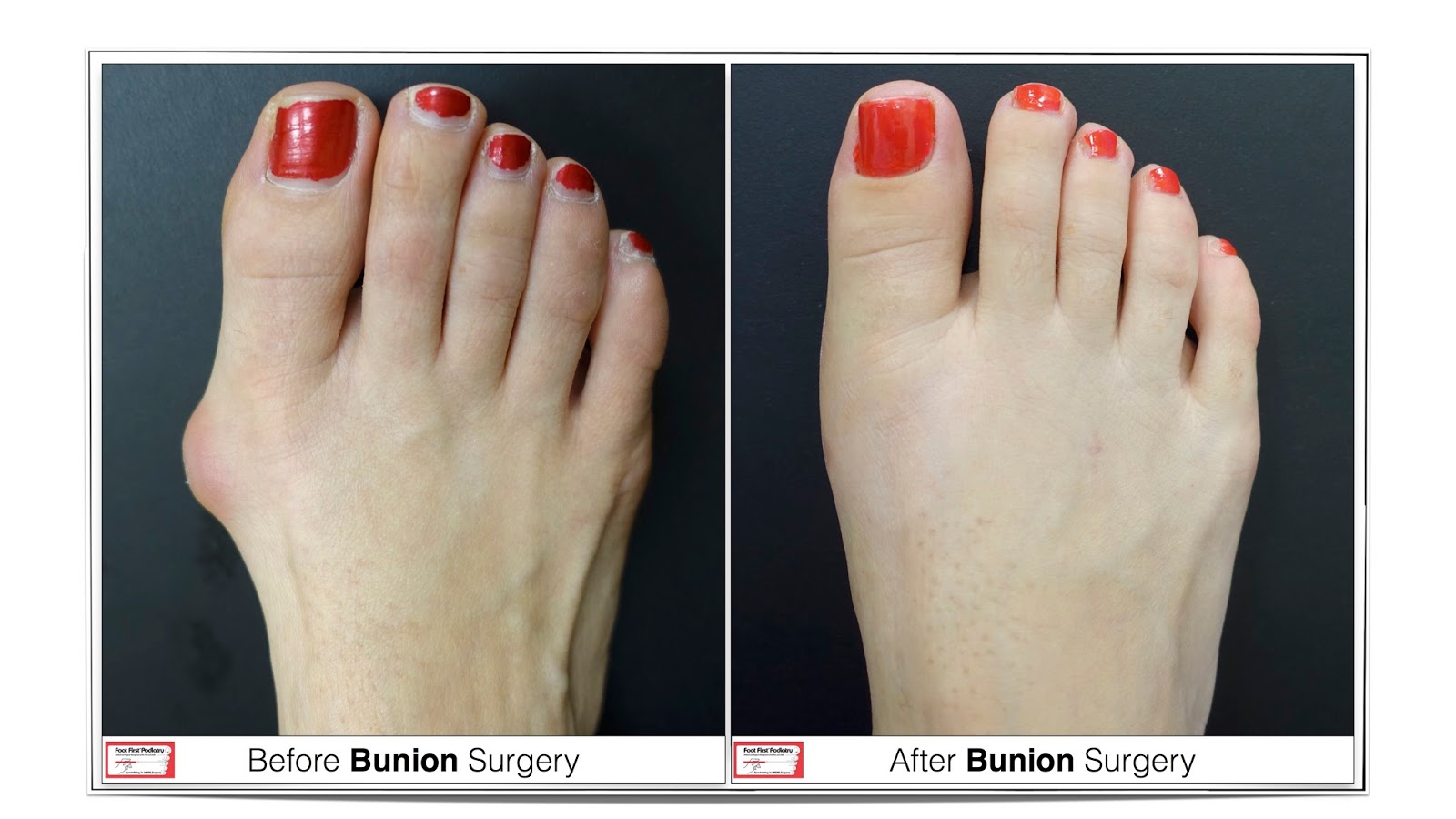 Swiss Compression Technique for Correcting Bunions PostOperative Care after Bunion Surgery A