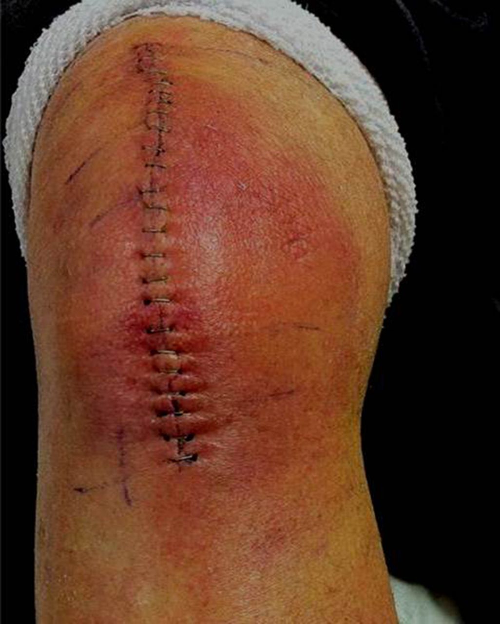 Total Knee replacement home exercise akufisio.blogspot