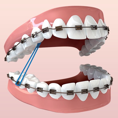 The Girl With the Screwed Up Jaw: 5 Weeks