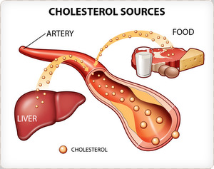 Dampak Kolesterol Tinggi 