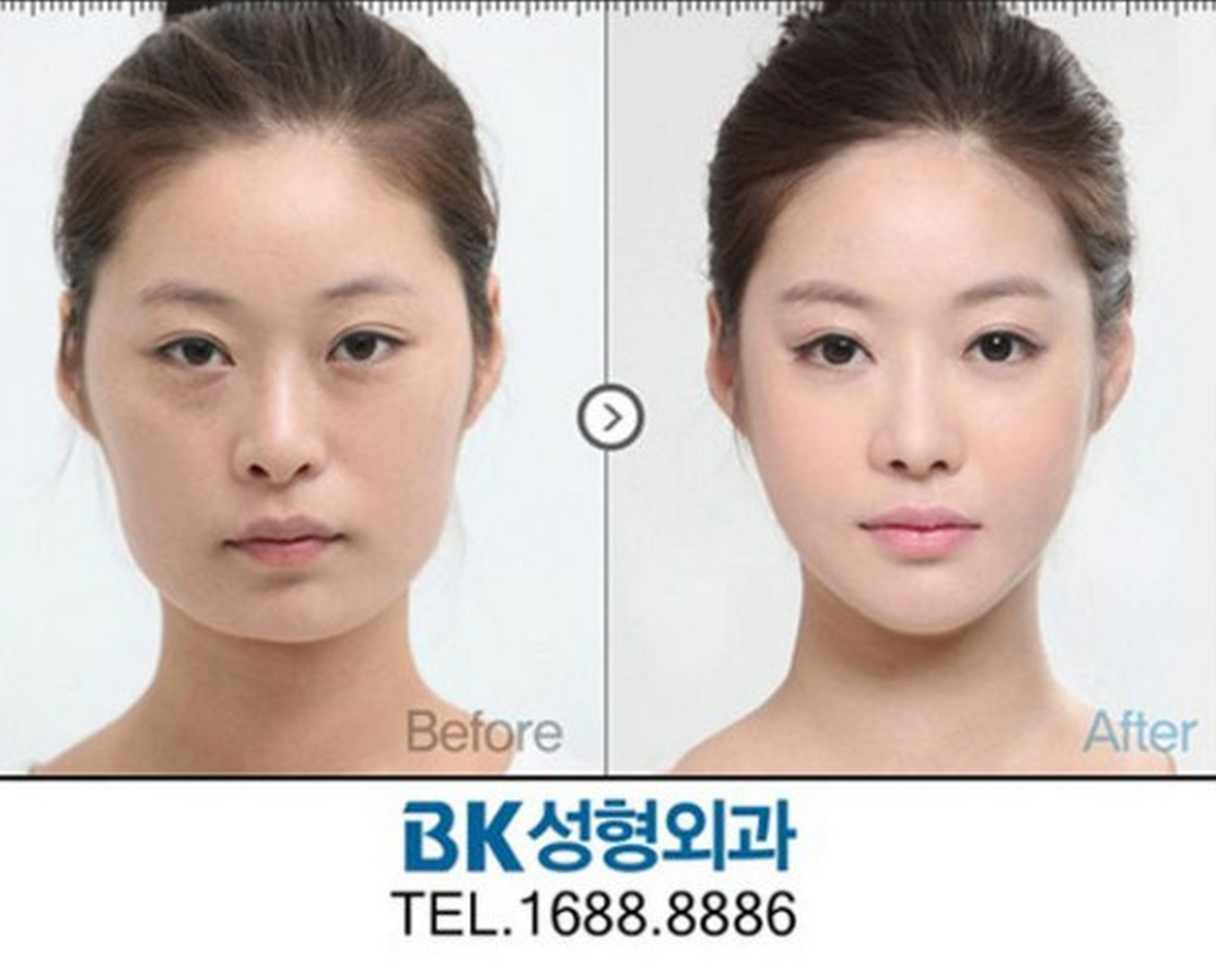 20 Almost Unrecognizable Plastic Surgery Before & Afters