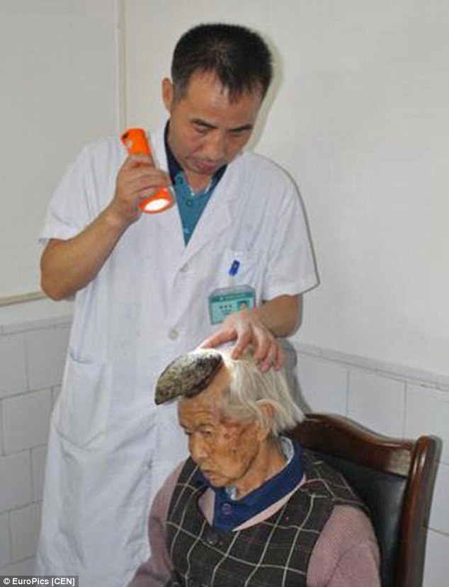 An Old Chinese Woman Grown a 5 Inch Horn on Her Forehead World Media File