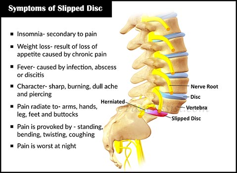 simptom-simptom slipped disc