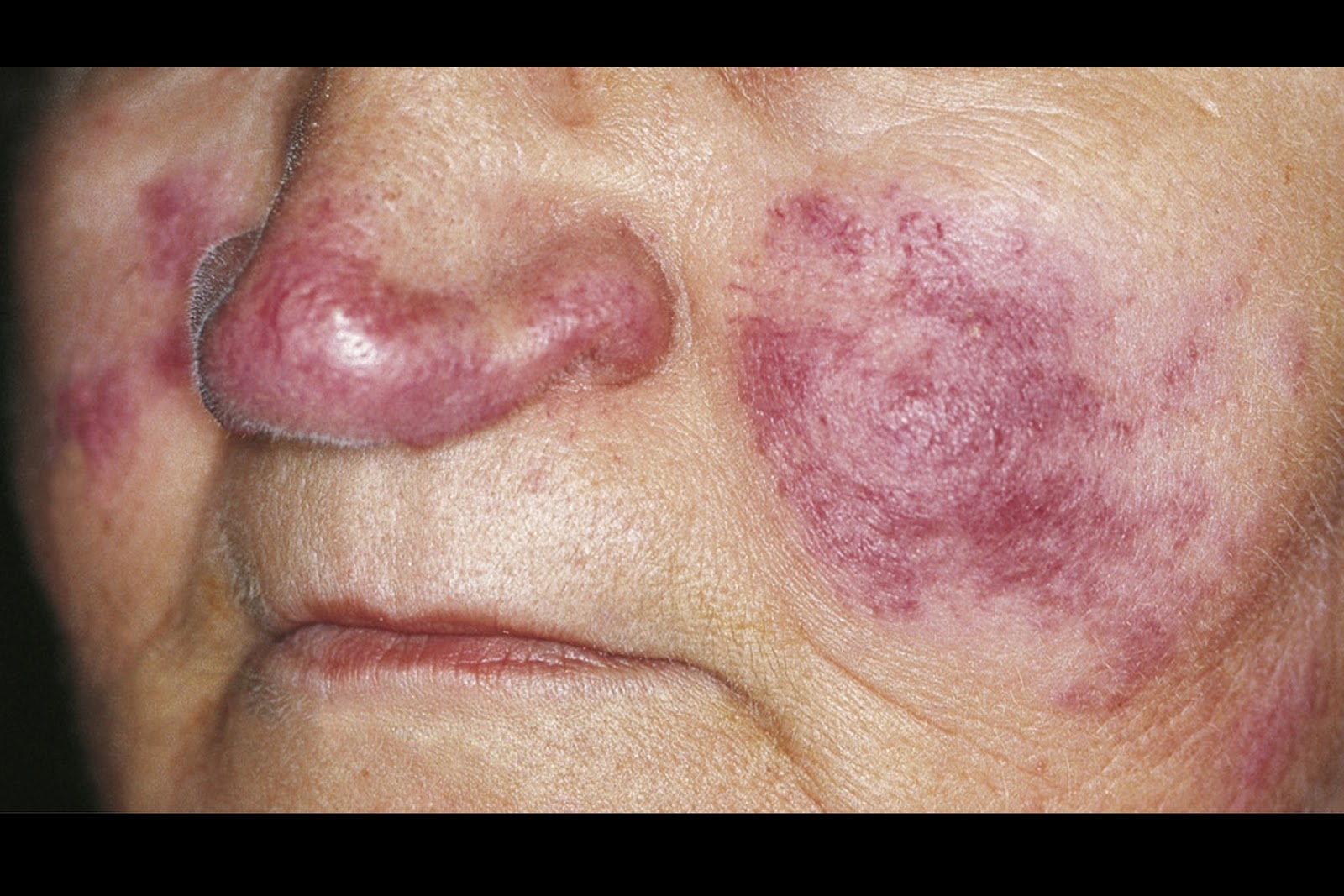 Discoid Lupus Symptoms, Diagnosis, Treatments and Causes ...