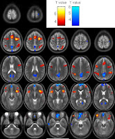 aa+fmri image
