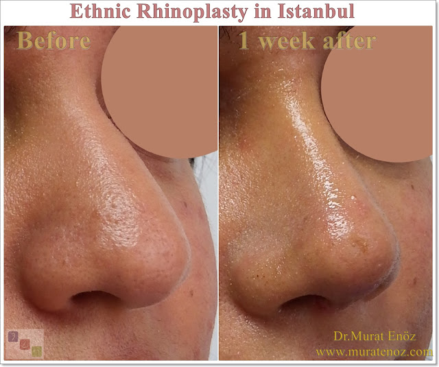 Ethnic Rhinoplasty In Istanbul