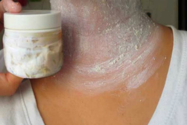 Retire las manchas oscuras molestos en el cuello, las axilas y el interior se notó en 15 Minutos Retire las manchas oscuras molestos en el cuello, las axilas y el interior se notó en 15 Minutos