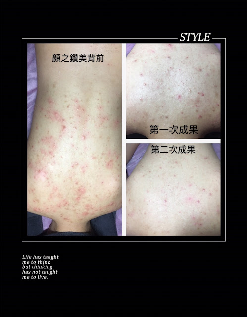 顏之鑽高雄美容做臉清粉刺除痘痘護膚SPA,奎蒂絲杏仁酸精華液, 高雄左營岩盤浴推薦, 高雄全身去角質推薦, 高雄美容沙龍推薦, 高雄美容SPA推薦, 高雄做臉清粉刺推薦, 高雄WAXXXX熱蠟除毛推薦, 顏之鑽高雄美容做臉清粉刺除痘痘護膚SPA,高雄左營美容店,左營美容SPA護膚, 高雄左營做臉,高雄左營做臉推薦,高雄左營做臉分享,高雄左營做臉評價,高雄左營做臉價格, 高雄左營清粉刺,高雄左營清粉刺推薦,高雄左營清粉刺店家,高雄左營清粉刺推薦店家,高雄左營清粉刺價格, 高雄左營清粉刺評價,高雄左營清粉刺分享,高雄左營清粉刺便宜,高雄左營無痛清粉刺,高雄左營擠粉刺, 高雄左營美顏店推薦,高雄左營美顏店家, 高雄左營美容店推薦, 高雄左營熱蠟除毛,高雄左營熱蠟除毛便宜,高雄左營熱蠟除毛分享,高雄左營熱蠟除毛評價,高雄左營熱蠟除毛價格, 高雄左營熱蠟除毛推薦,高雄左營蜜蠟除毛評價,高雄左營蜜蠟除毛便宜,高雄左營蜜蠟除毛價格,高雄左營蜜蠟除毛推薦, 高雄左營腋下除毛評價,高雄左營腋下除毛推薦,高雄左營腋下除毛價格,高雄左營腋下除毛分享,高雄左營腋下除毛便宜, 高雄左營私密處除毛評價,高雄左營私密處除毛推薦,高雄左營私密處除毛價格,高雄左營私密處除毛便宜, 高雄左營岩盤浴SPA,高雄左營岩盤浴,高雄左營岩盤浴推薦,岩盤浴高雄左營