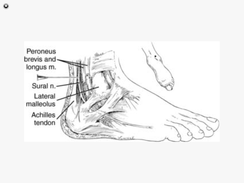 SRNA Daily Review REGIONAL ANESTHESIA BLOCKS