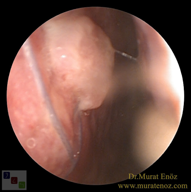 Extracorporeal septum perforation closure in Istanbul - Extracorporeal septum perforation closure in Turkey - Extracorporeal closure of nasal septal perforations subcutaneous tissue - Combining rhinoplasty with extracorporeal septal perforation repair - Repair of nasal septum Perforation