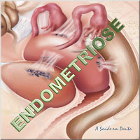 Endometriose: a presença do endométrio fora do seu local habitual que é o útero