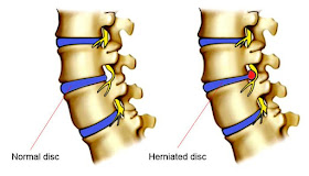 normal and herniated disk