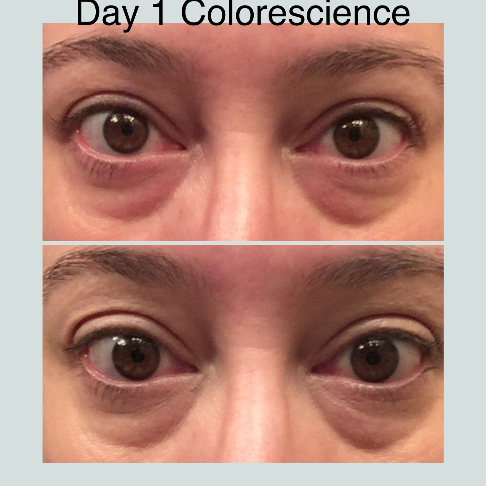 total eye renewal therapy