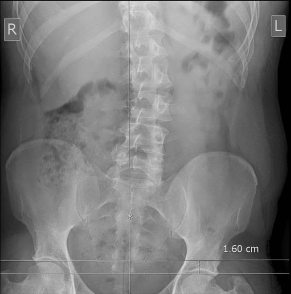 Foot and Ankle Problems By Dr. Richard Blake Short Leg Syndrome Email