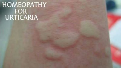 Homeopathy for Urticaria