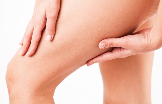Cara Menghilangkan Stretch Mark Cara Menghilangkan Stretch Mark