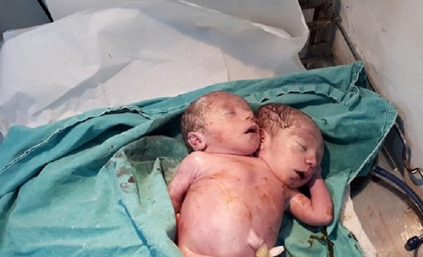 ولادة-طفل-برأسين-بإدلب-شمالي-سوريا