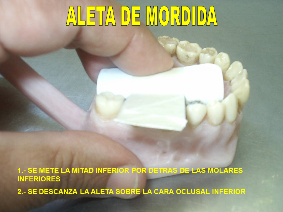 Radiología: 2° PARCIAL OCLUSAL Y ALETA DE MORDIDA