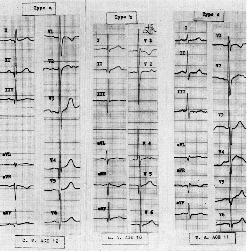 Dr. Smith's ECG Blog Why does this young male with chest pain have a