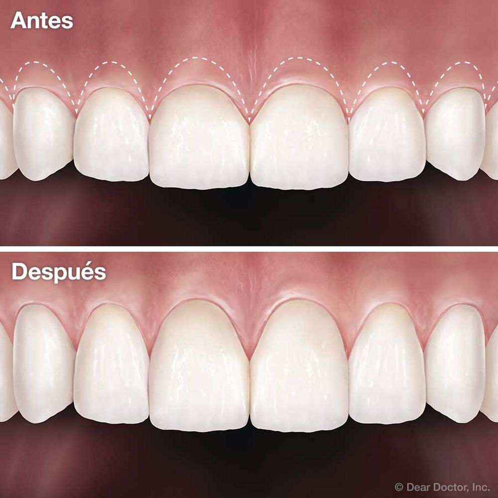 PERIODONCIA Cirugía Estética Periodontal Directorio Odontológico
