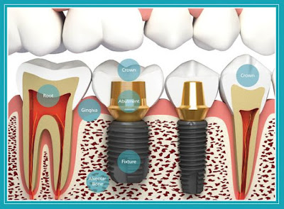Cấy ghép răng implant là gì cay-ghep-rang-implant-la-gi