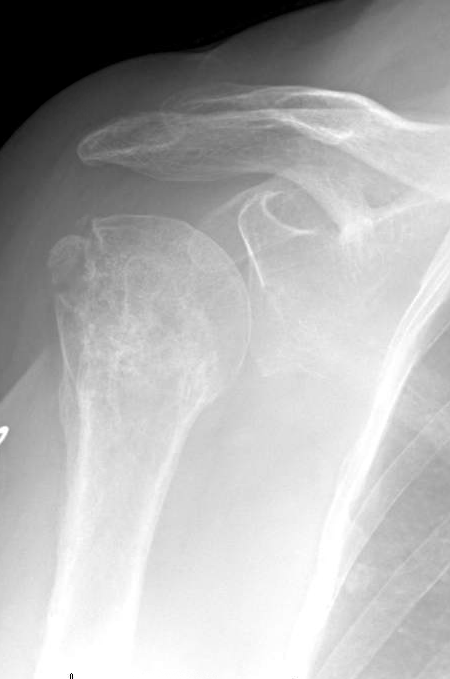 Shoulder and Elbow Surgery Osteoporosis and collapse of the head after ORIF of the proximal