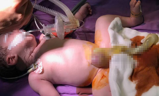 Nội tạng lòi ra ngoài khi vừa mới chào đời Nội tạng lòi ra ngoài khi vừa mới chào đời