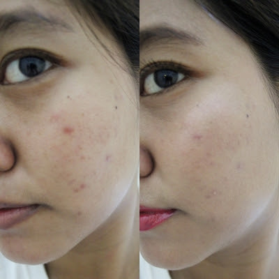 Acne prone skin adalah