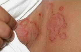 obat herbal untuk mengatasi gatal di sela payudara obat herbal untuk mengatasi gatal di sela payudara