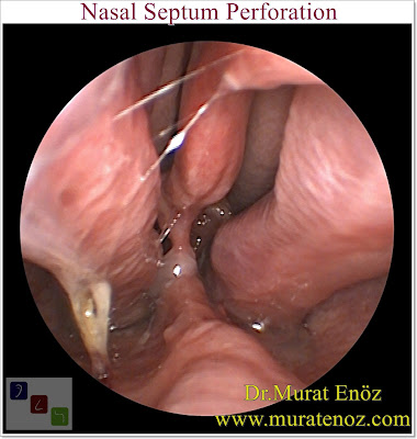 Nasal Septal Perforation - Nasal Septum Perforation