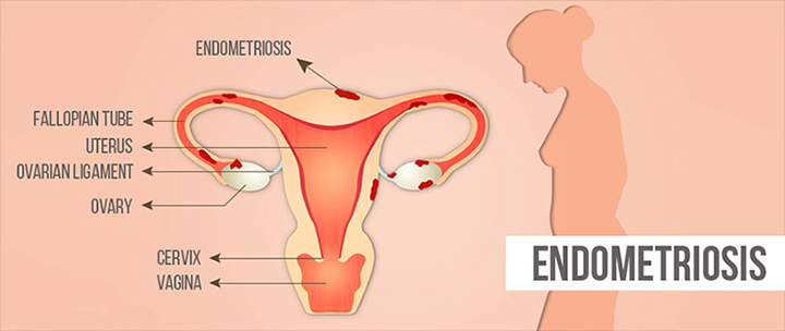 endometriosis, ayurvedic treatment, diet, avoid surgery