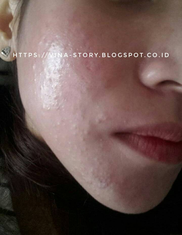 Mommies Beauties Journal Pengalaman Lepas Krim Dokter Atau Perawatan Di Dokter Spkk Breakout Trial Error Purging Acne Fight Survive Part 1