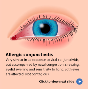 allergic conjunctivitis cold compress allergic conjunctivitis cold compress