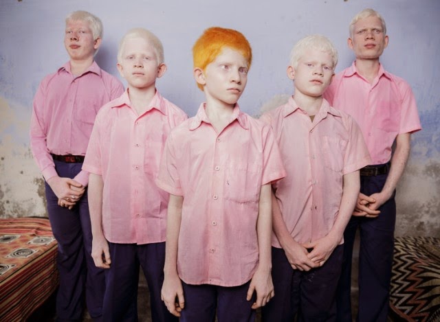 Niños albinos ciegos