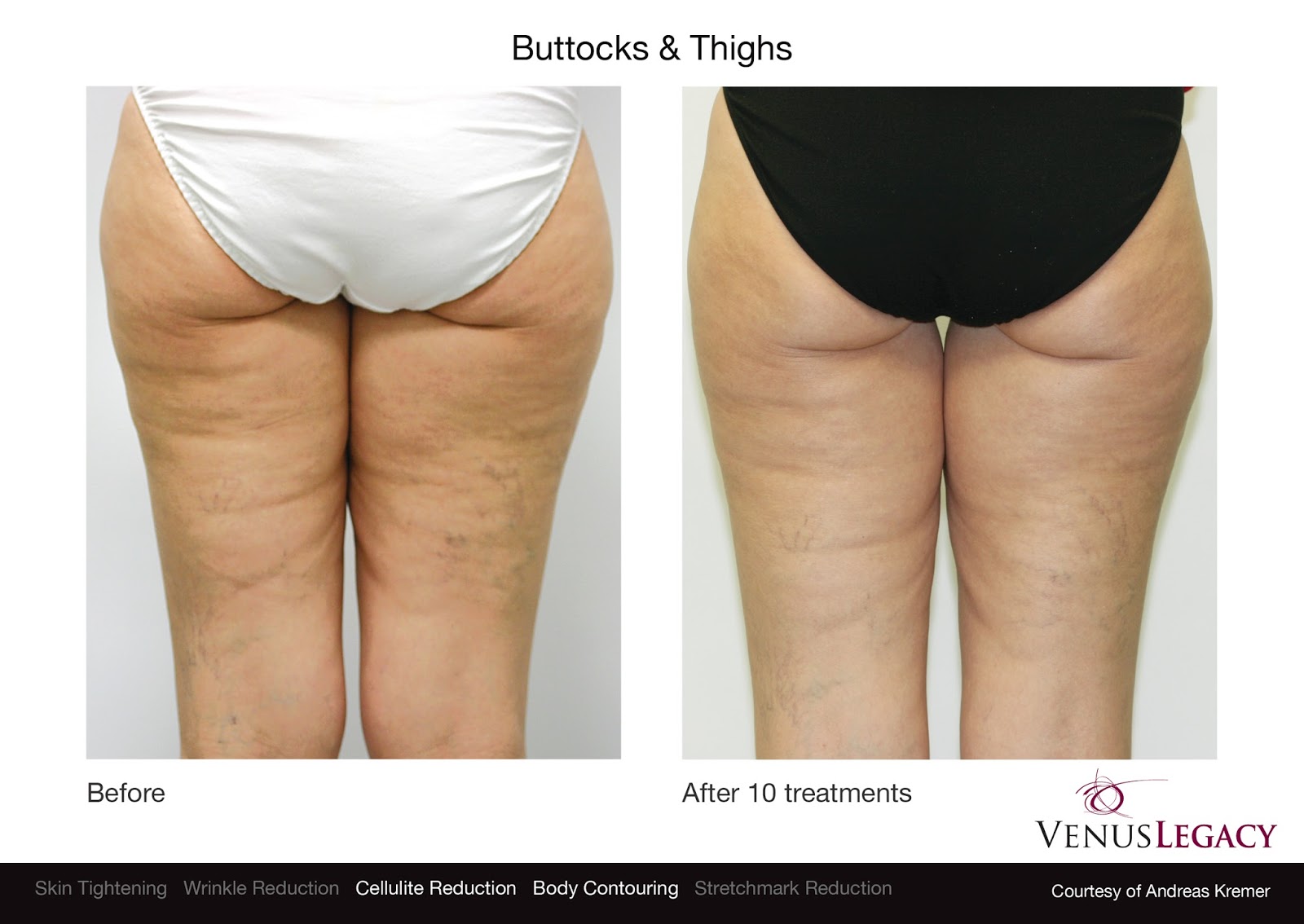 Как убрать целлюлит с задней стороны бедра быстро Как убрать целлюлит с задней стороны бедра быстро