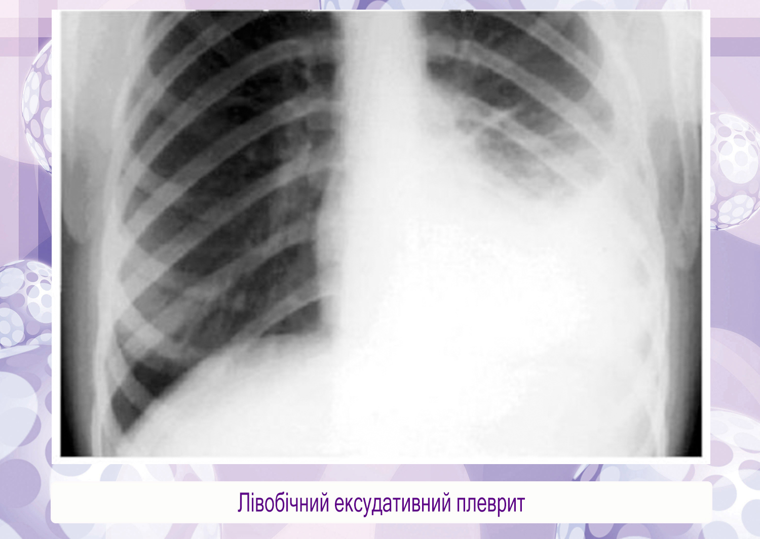 экссудативный плеврит классификация. интерлобарный плеврит. экссудативный плеврит справа рентген. косто-диафрагмальный плеврит. экссудативный плеврит мкб 10.