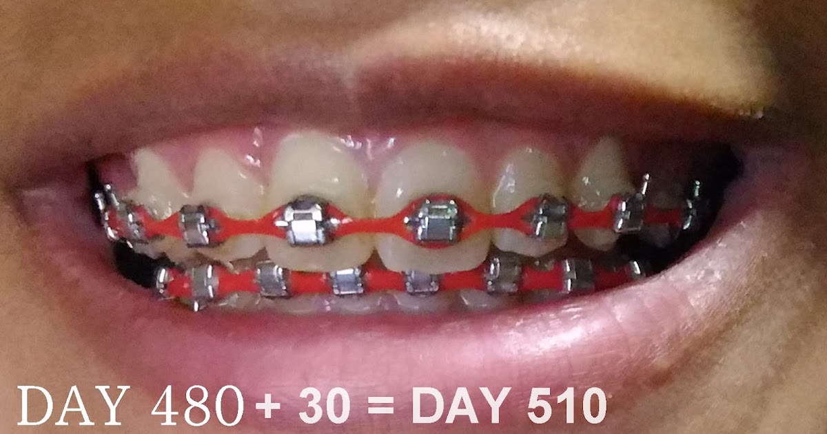 Pengalaman Setahun Lima Bulan dengan Braces fatimahnabila