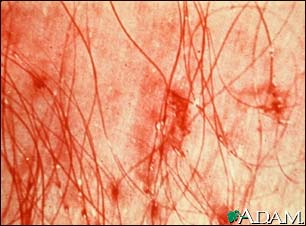 How about a new lifestyle?: PEDICULOSIS AND ITS TREATMENT