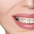 أسباب حدوث إنتكاس بعد إزالة التقويم الاسنان