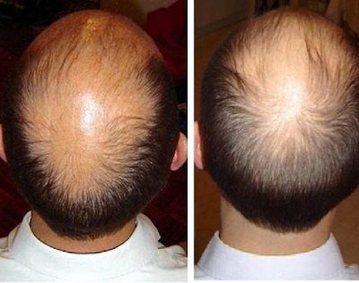 10 Cara Alami untuk Menumbuhkan Rambut Botak dengan Cepat dan Muadah
