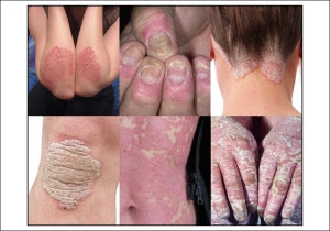 Cara cepat Menyembuhkan penyakit kulit PSORIASIS Cara cepat Menyembuhkan penyakit kulit PSORIASIS