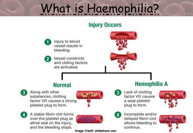 Physio knowledge BD: Hemophilia