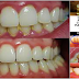 Remove the Tartar on your Teeth by Using Only a Tablespoon of Coconut Oil Every day!